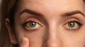 Yellow Eyes: What Does It Mean? 